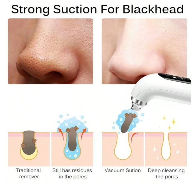 Succionador Eléctrico de Puntos Negros